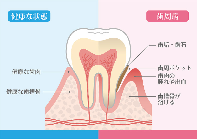 歯周病の図解