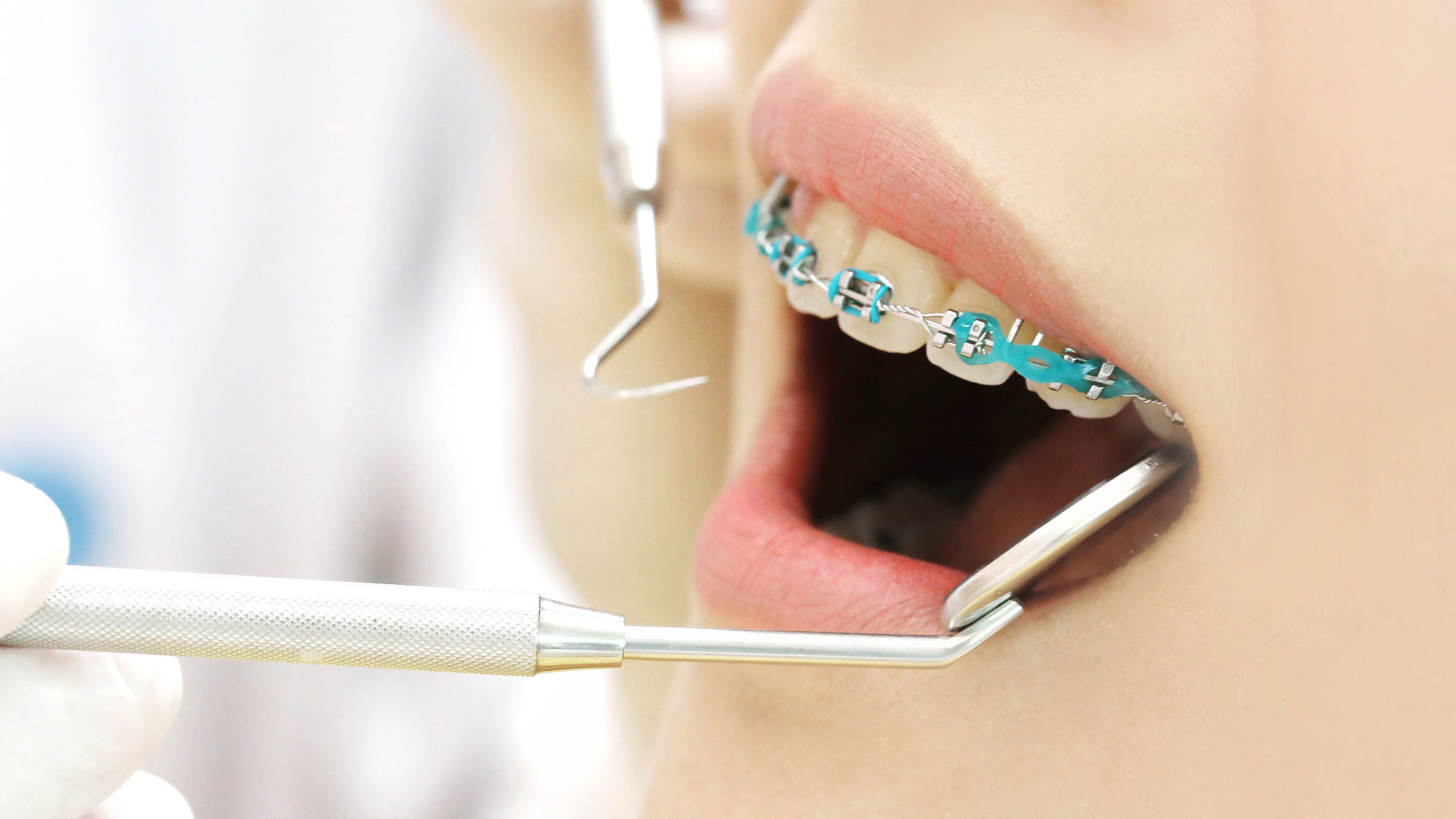 表側矯正中の女性の口元写真