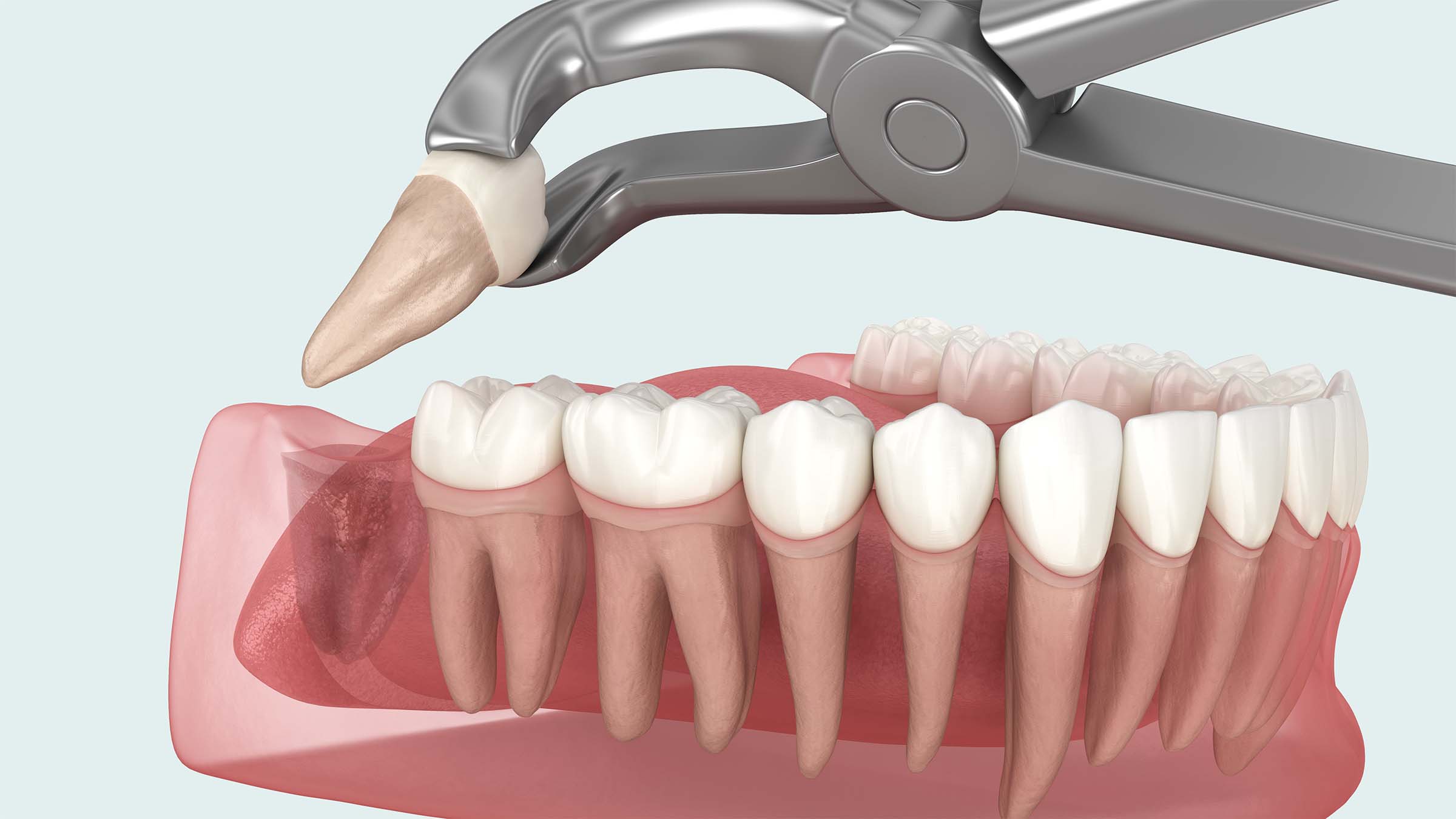 親知らずの抜歯3Dイメージ